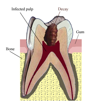 A tooth in need of RCT