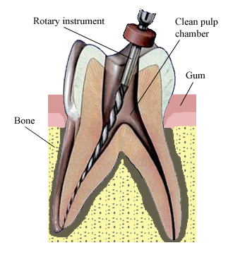 A tooth during RCT